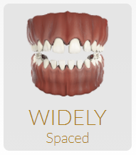 invisalign for widely spaced teeth