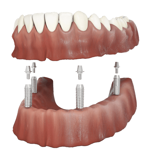 Implant Retained Dentures Dulwich & Forest Hill