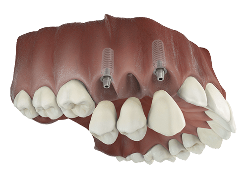multiple teeth implants forest hill & dulwich