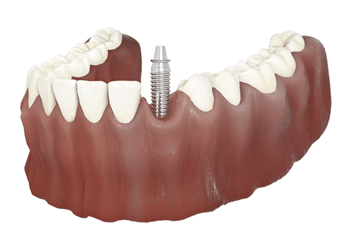 single tooth implant forest hill & dulwich