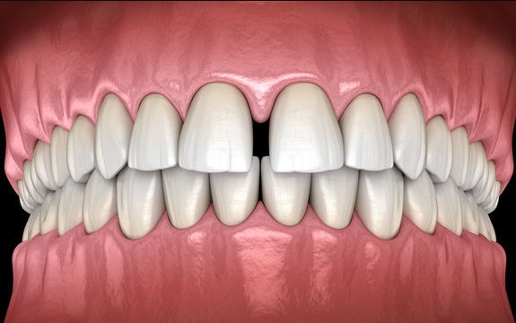 gap teeth treatment in forest hill using invisalign